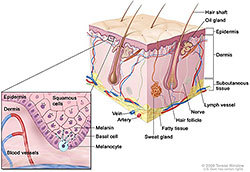Illustration of melanoma.