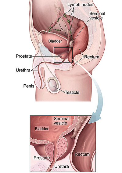 Prostate Cancer — Cancer Stat Facts 